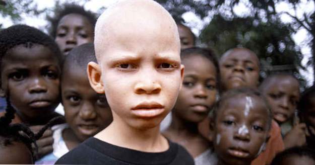 10 tragische Fakten über Albino-Jagd in Afrika (Kriminalität)